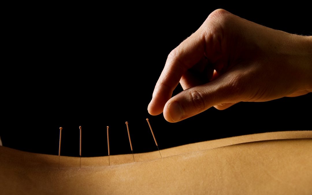 5 Benefits of Acupuncture